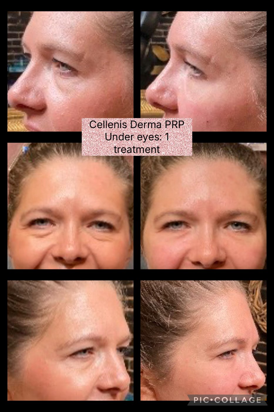 Cellenis Derma PRP before and after under-eye treatment results