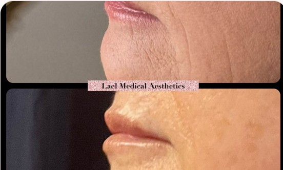 Lael Medical Aesthetics before-and-after facial profile