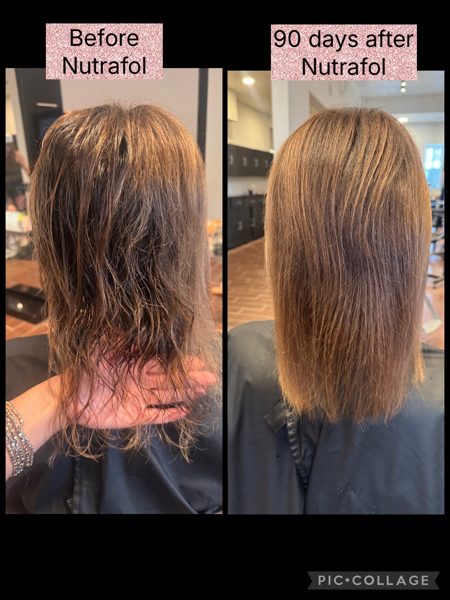 Nutrafol hair restoration before and 90 days after