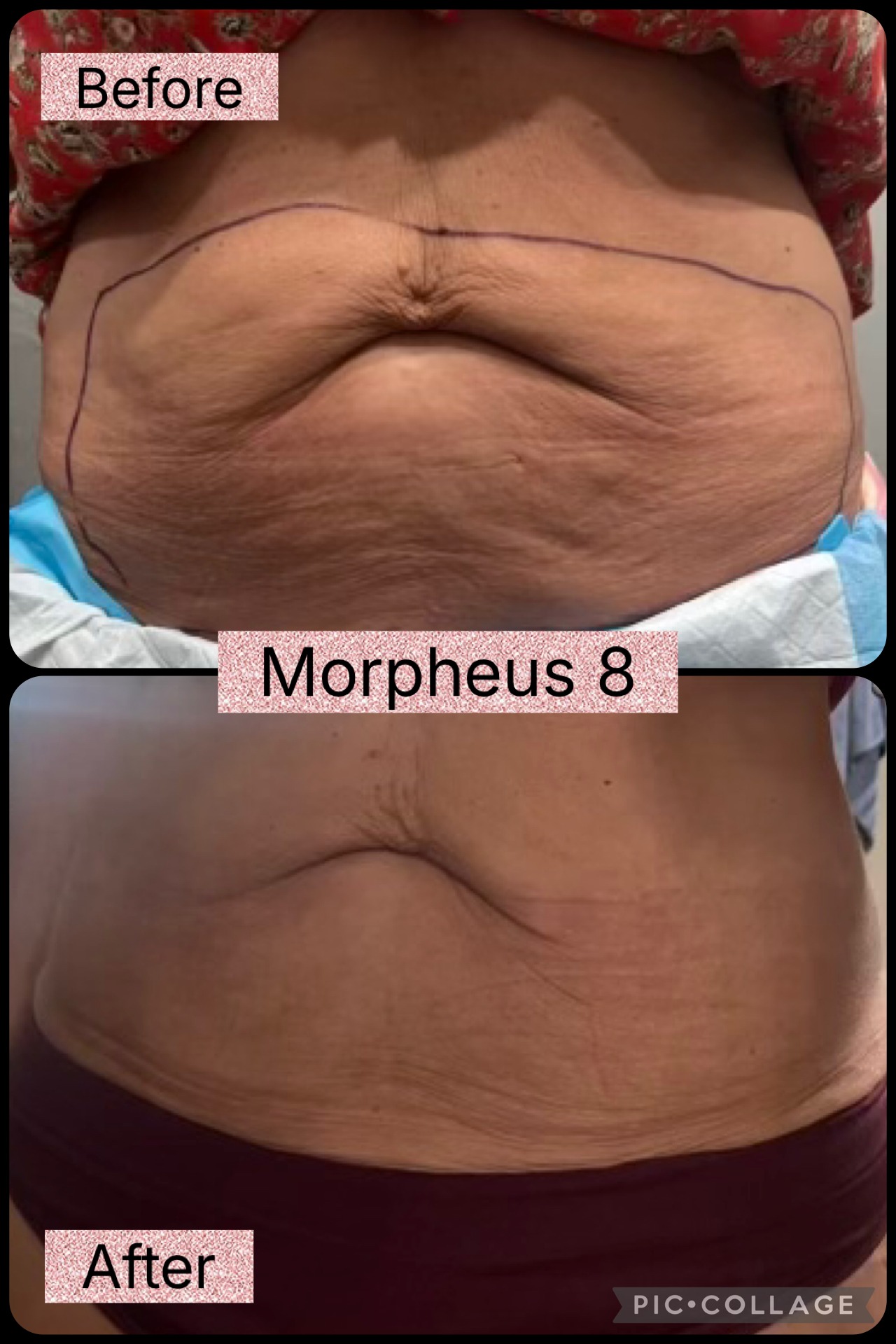 Morpheus8 before and after results