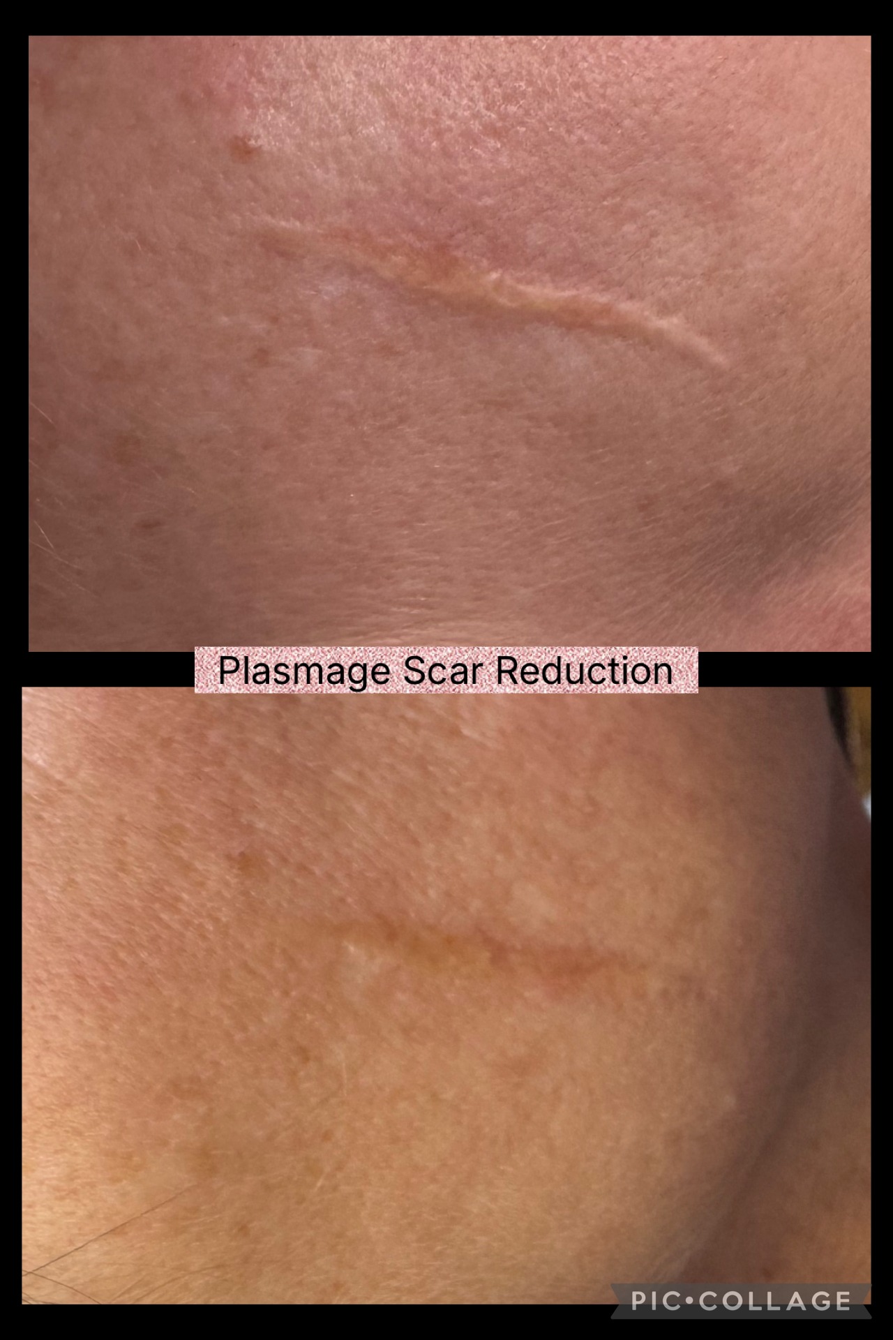 Plasmage scar reduction before and after at Lael Medical Aesthetics
