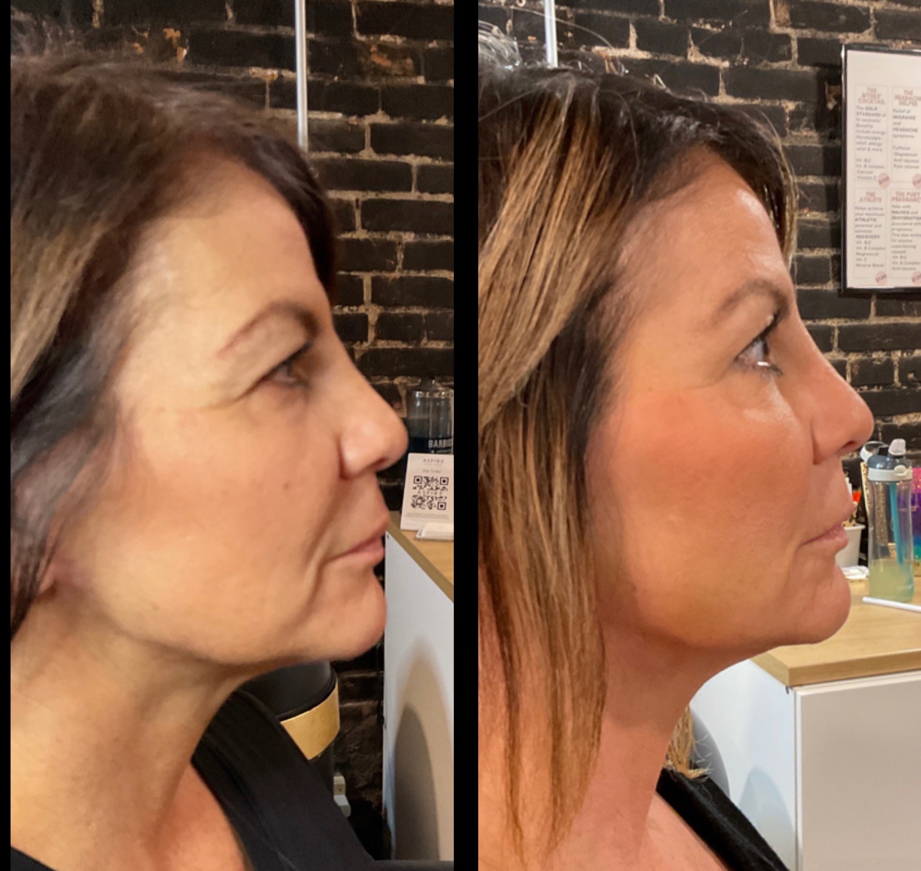 Sculptra® treatment photograph