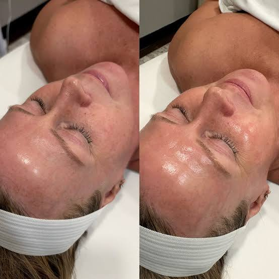 ZO® Stimulator Peel treatment photograph