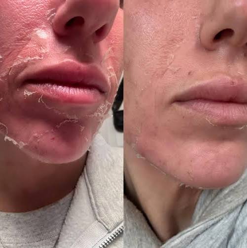 ZO® 3-Step Peel treatment photograph